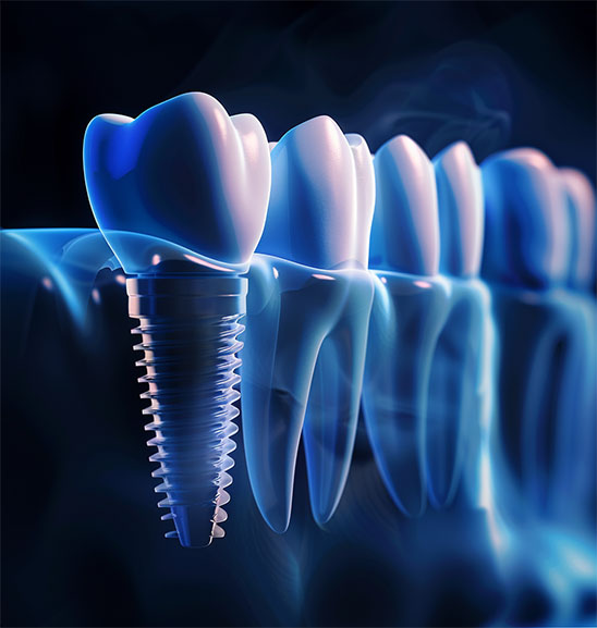 Dental implant failure and complications