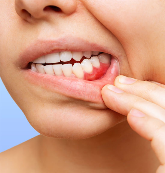 Untreated gum disease and periodontal damage